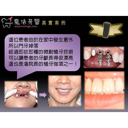 即拔即种 - Dental Implants-18 即拔即种 - Dental Implants-18