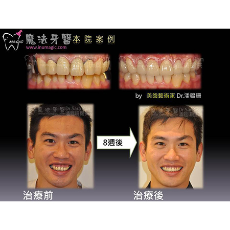 大暴牙 - Full Mouth Reconstruction-4 大暴牙 - Full Mouth Reconstruction-4
