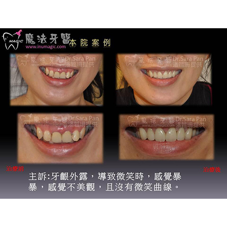 暴牙 - Dental Orthodontic-7 暴牙 - Dental Orthodontic-7