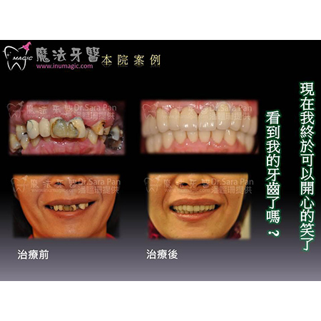 水雷射植牙 - Dental Laser-6 水雷射植牙 - Dental Laser-6