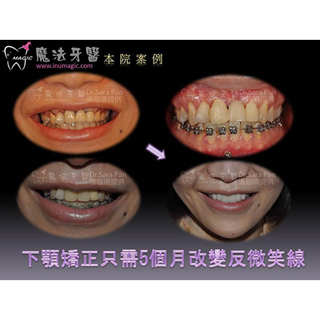 牙齿矫正器 - Dental Orthodontic-2 牙齿矫正器 - Dental Orthodontic-2