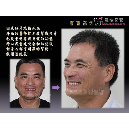 糖尿病植牙 - Dental Implants-19 糖尿病植牙 - Dental Implants-19