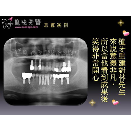 全口植牙 - Dental Implants-14 全口植牙 - Dental Implants-14
