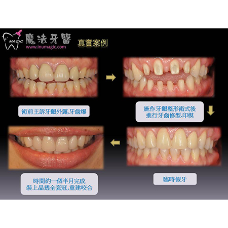 临时假牙 - Dental Prosthodontics-2 临时假牙 - Dental Prosthodontics-2