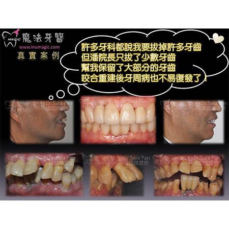 雷射植牙 - Dental Laser-7 雷射植牙 - Dental Laser-7
