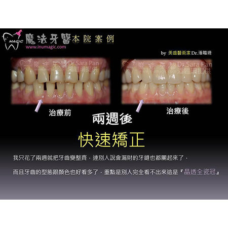 牙齿贴片 - Dental Esthetics-1 牙齿贴片 - Dental Esthetics-1