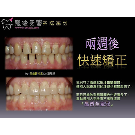 牙齿美白贴片 - Dental Esthetics-7 牙齿美白贴片 - Dental Esthetics-7