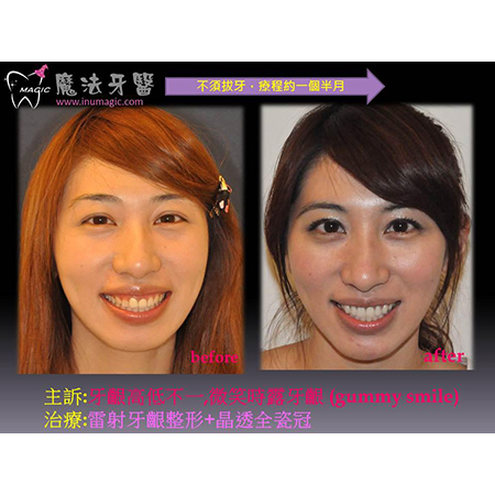 脸变小 - Dental Orthodontic-11 脸变小 - Dental Orthodontic-11
