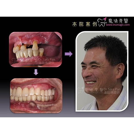 缺牙后遗症 - Good Dentist-14 缺牙后遗症 - Good Dentist-14