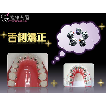 舌侧矫正 - Dental Orthodontic-5 舌侧矫正 - Dental Orthodontic-5