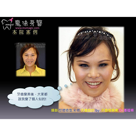 牙齿美白 - Dental Esthetics-9 牙齿美白 - Dental Esthetics-9