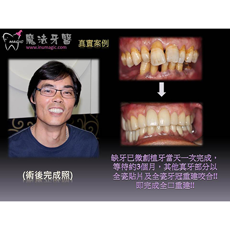 微创植牙 - Dental Laser-5 微创植牙 - Dental Laser-5