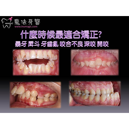 儿童矫正 - Children Dental-3 儿童矫正 - Children Dental-3