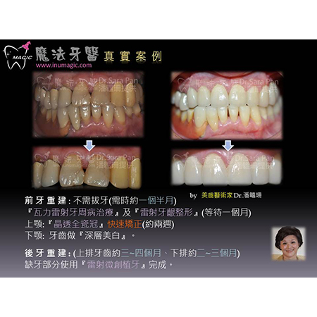 植牙好处 - Dental Implants-17 植牙好处 - Dental Implants-17
